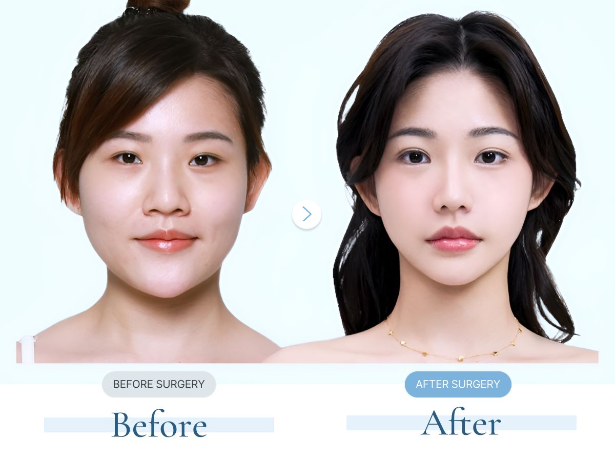 가상성형 샘플 윤곽 · Contouring
