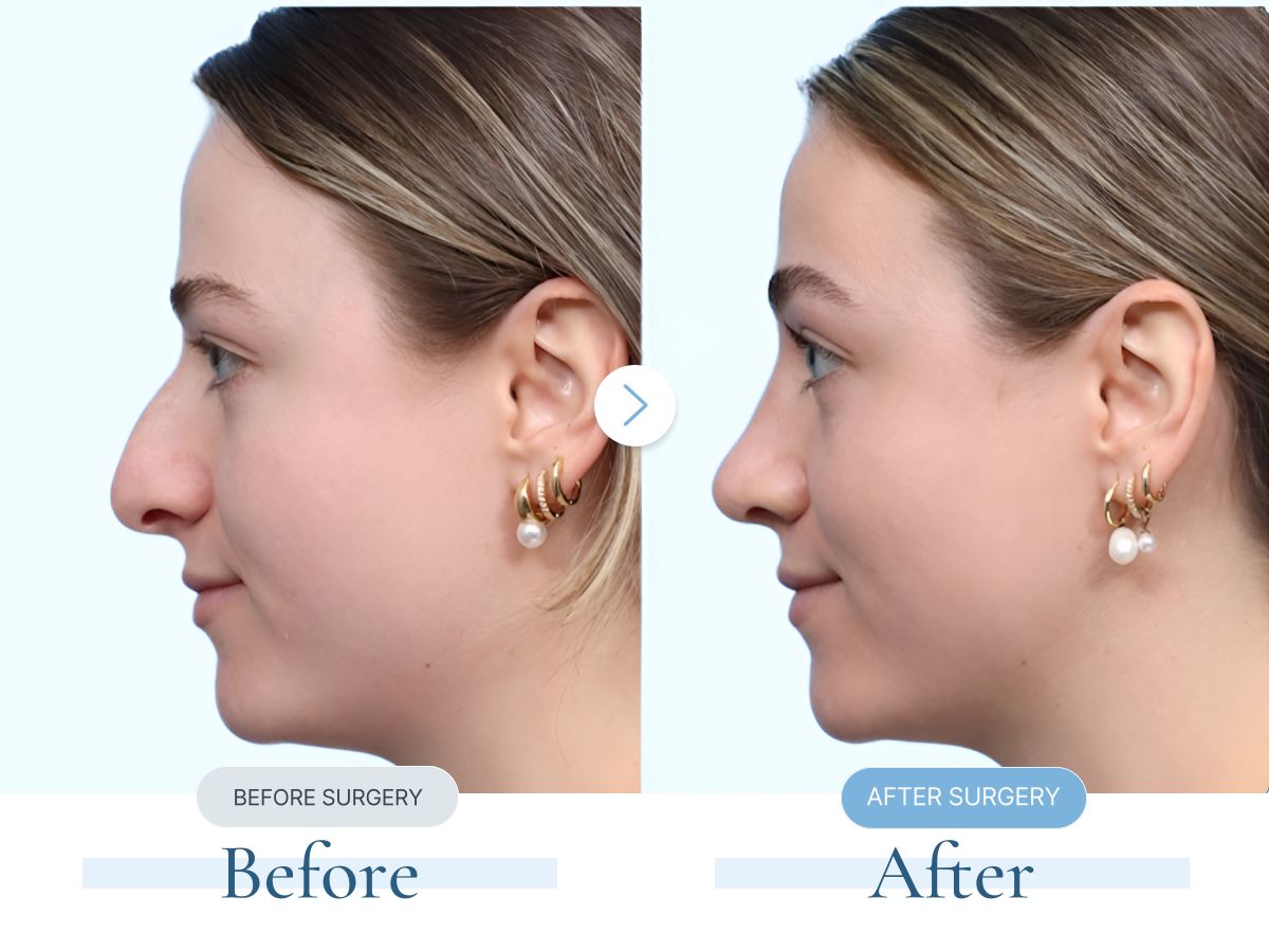 가상성형 샘플 코 · Rhinoplasty